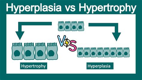how to say hypertrophy|Hypertrophy .